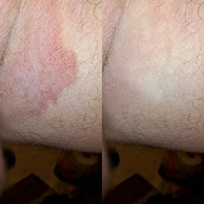 Jabón antimicótico Alivera® Anti Tiña Inguinal - Formula natural antifúngica.
